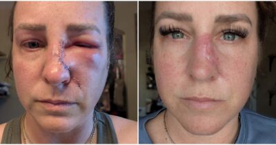 Copertina di “Pensavo fosse pelle secca, ma era un tumore. Ora mi è rimasto un buco grande quanto una moneta sul naso”: la storia di Amanda Anderson