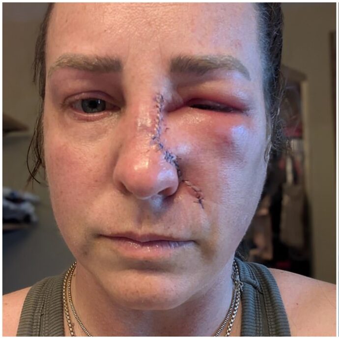 “Pensavo fosse pelle secca, ma era un tumore. Ora mi è rimasto un buco grande quanto una moneta sul naso”: la storia di Amanda Anderson