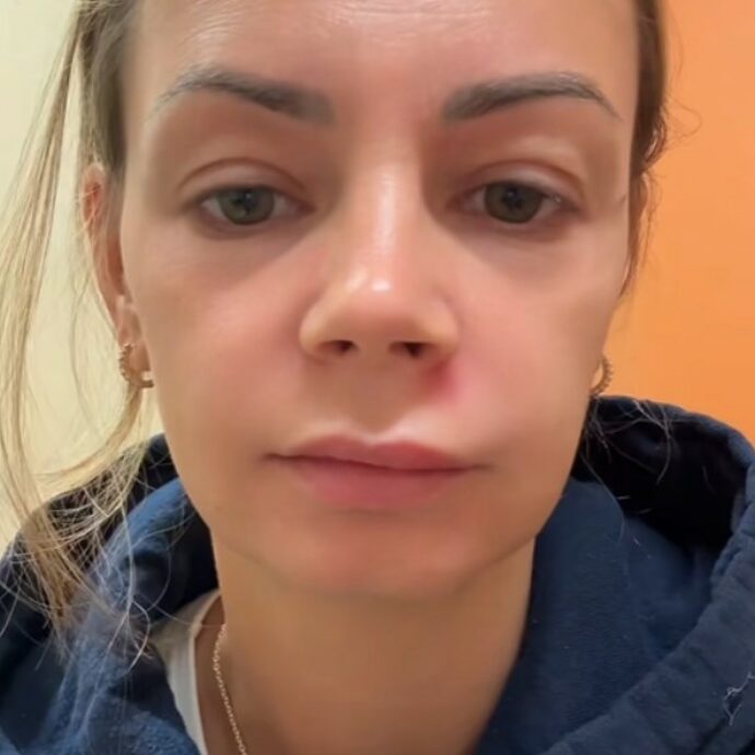 “Ho schiacciato un brufolo nel ‘triangolo della morte’ e ho rischiato la vita”. Che cos’è e il monito degli esperti: “Non fatelo, può essere letale”