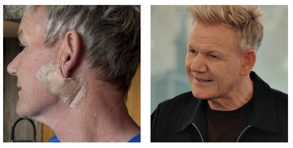 ho scoperto un cancro alla pelle e sono stato operato giuro non 232 un lifting parla lo chef gordon ramsey