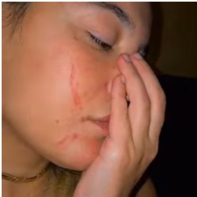 “I graffi sul viso parlano da soli. Le ferite passeranno ma il trauma no”: l’influencer Marilena Sansone aggredita da una stalker “vegana” perché mangia solo carne cruda