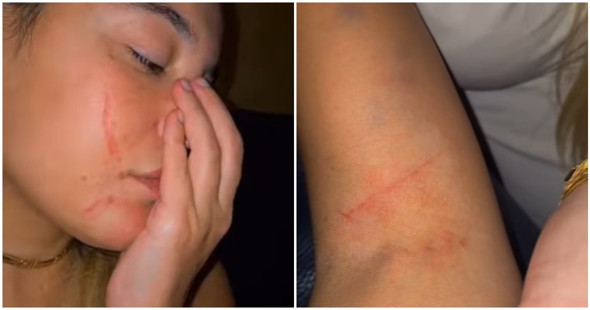 i graffi sul viso parlano da soli le ferite passeranno ma il trauma no l8217influencer marilena sansone aggredita da una stalker vegana perch233 mangia solo carne cruda