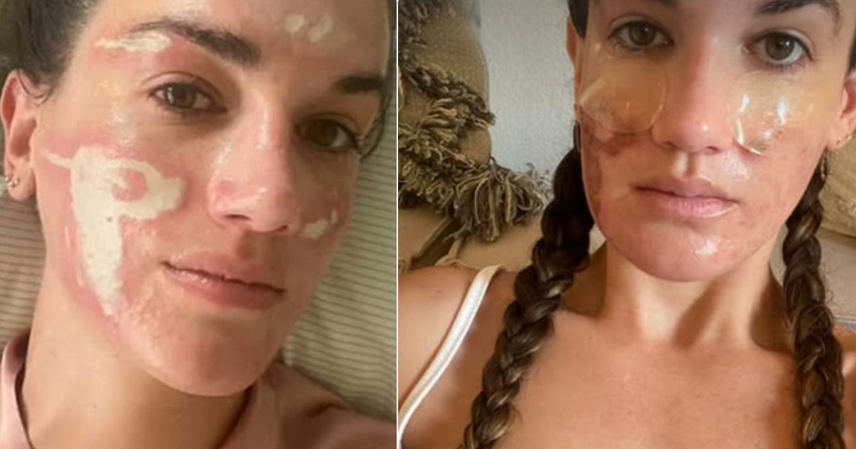 “L’estetista di Jennifer Lopez mi ha rovinato la pelle. Mi ha fatto spendere 30mila dollari e ho ustioni e cicatrici permanenti”: la storia di Victoria Nelson