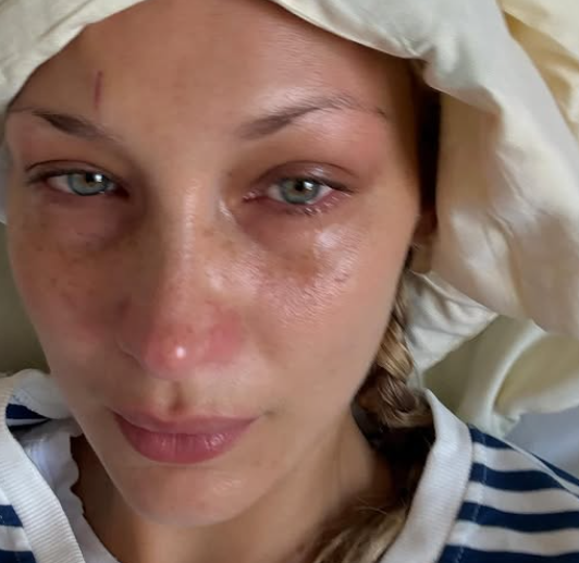 “Scusate se sparisco sempre, sono in missione”: Bella Hadid ricoverata in ospedale, le foto con le flebo e le trasfusioni per la malattia di Lyme