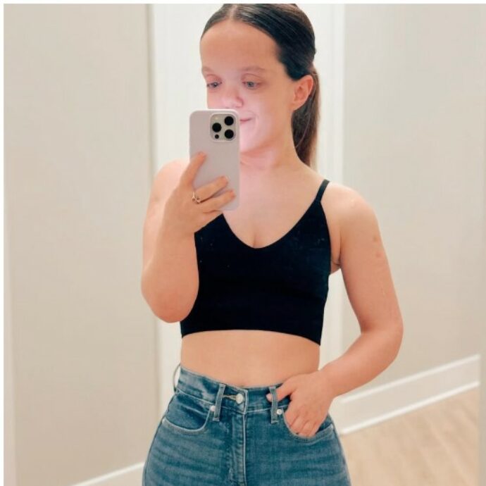 “Non mi sono mai sentita nana, ma odiavo essere trattata come una cane da esposizione. Ora sono una ‘bassa comoda’”: la storia di Chandler Crews, che ha speso 2 milioni per farsi allungare gambe e braccia