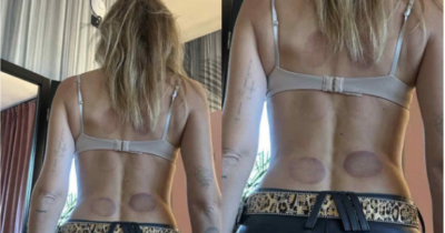 Copertina di Cos’è e quali rischi porta con sé la Cupping Therapy sdoganata da Chiara Ferragni: “Può causare effetti collaterali anche gravi”