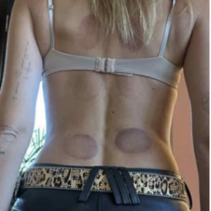 Cos’è e quali rischi porta con sé la Cupping Therapy sdoganata da Chiara Ferragni: “Può causare effetti collaterali anche gravi”