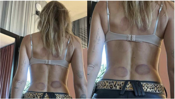 cos8217232 e quali rischi porta con s233 la cupping therapy sdoganata da chiara ferragni pu242 causare effetti collaterali anche gravi