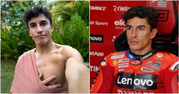 Marc Marquez operato alla spalla destra: “Non c’erano segni sufficienti di stabilizzazione”. Incertezza sul recupero