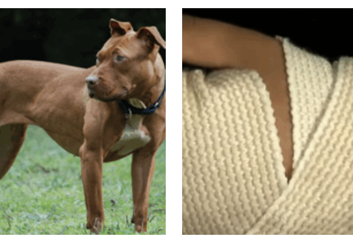 “Un pitbull senza guinzaglio ha attaccato mia figlia, sono riuscita ad afferrarla ma lui allora mi ha morso la mano”: il drammatico assalto e la decisione di sopprimere il cane