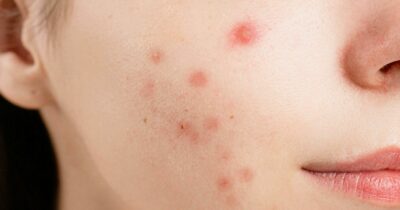 Copertina di “Hai i brufoli, non puoi essere bella”: cos’è l’acne shaming, il trend tossico che sta devastando la Gen Z sui social