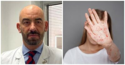 Copertina di “Quasi 1560 casi e primi morti dopo 10 anni”: è allarme per l’epidemia di morbillo negli Stati Uniti. L’ira di Bassetti: “Siamo tornati indietro agli anni ’70”