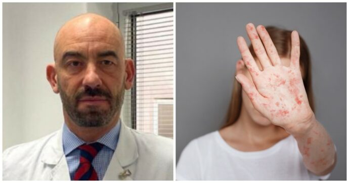 “Quasi 1560 casi e primi morti dopo 10 anni”: è allarme per l’epidemia di morbillo negli Stati Uniti. L’ira di Bassetti: “Siamo tornati indietro agli anni ’70”