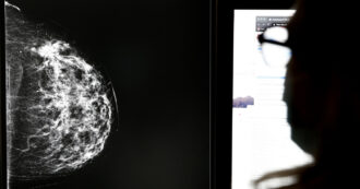 Mammografie “dubbie” ma donne mai ricontattate: lo scandalo degli screening oncologici travolge l’Andalusia