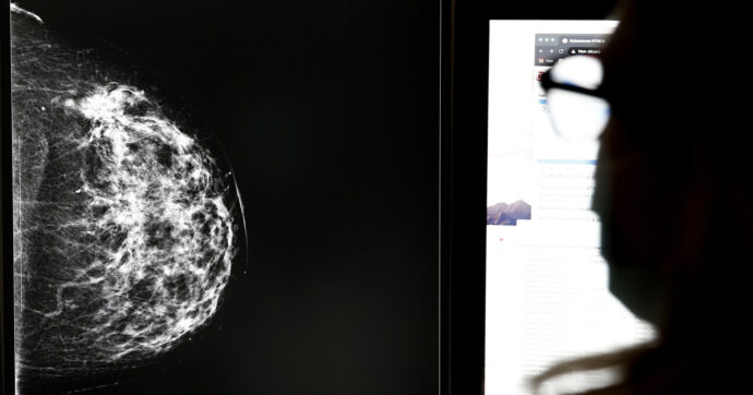 Mammografie “dubbie” ma donne mai ricontattate: lo scandalo degli screening oncologici travolge l’Andalusia