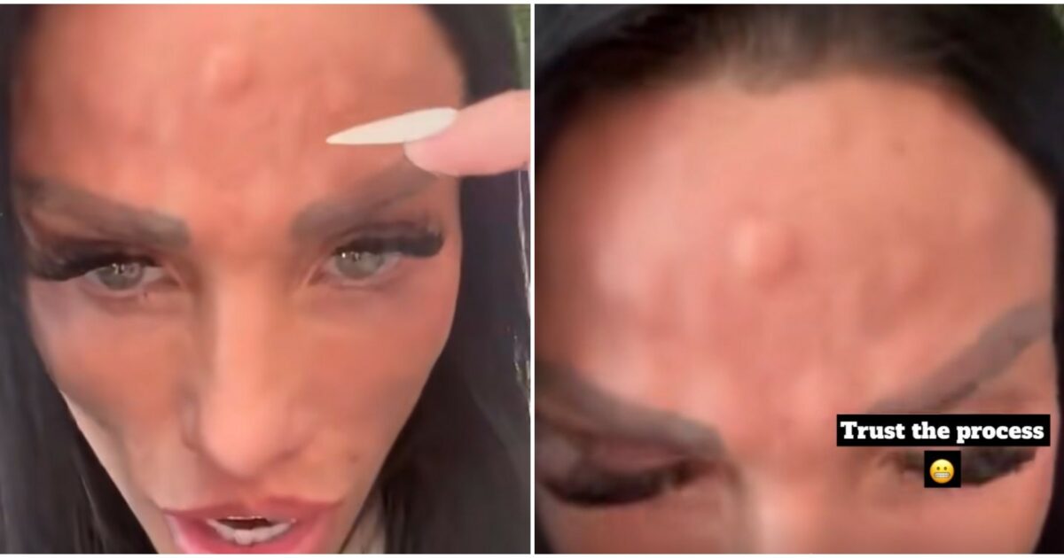 “Mi sono spuntate delle gobbe sulla fronte”: Katie Price mostra il suo viso dopo il trattamento con il botox “Mi sono spuntate delle gobbe sulla fronte”: Katie Price mostra il suo viso dopo il trattamento con il botox