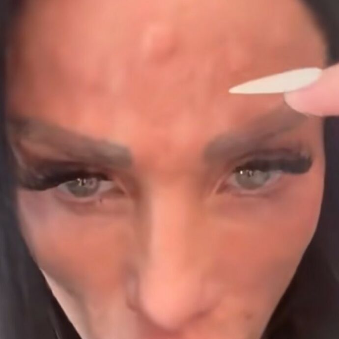 “Mi sono spuntate delle gobbe sulla fronte”: Katie Price mostra il suo viso dopo il trattamento con il botox