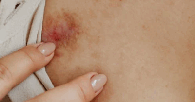 Copertina di “Vomito, nausea e lividi inspiegabili, pensavo fosse un’intolleranza poi la diagnosi insolita”: la malattia di Harriet Green e il lieto fine