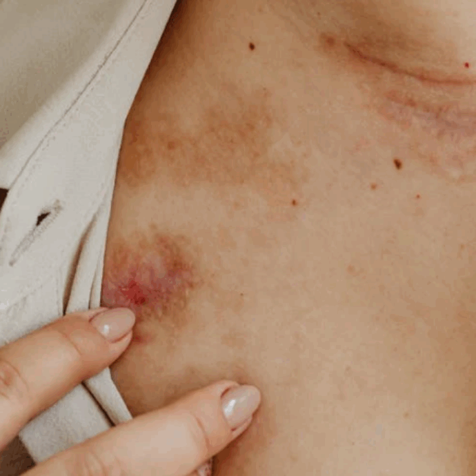 “Vomito, nausea e lividi inspiegabili, pensavo fosse un’intolleranza poi la diagnosi insolita”: la malattia di Harriet Green e il lieto fine