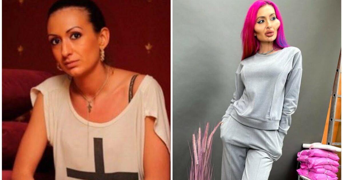 La donna con le guance più grandi al mondo stupisce i suoi fan: Anastasia Pokreshchuk pubblica una foto del suo volto prima della chirurgia estetica