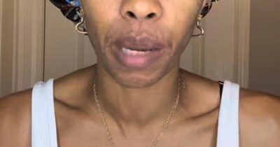 Copertina di “Ho sempre pensato che i capelli cadono e poi ricrescono, ma sono disperata. Ho usato un farmaco anti-caduta e ora sono più calva di prima”: lo sfogo in lacrime di Maria Cribbs