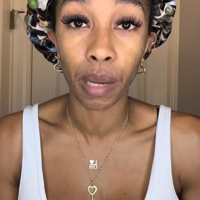 “Ho sempre pensato che i capelli cadono e poi ricrescono, ma sono disperata. Ho usato un farmaco anti-caduta e ora sono più calva di prima”: lo sfogo in lacrime di Maria Cribbs