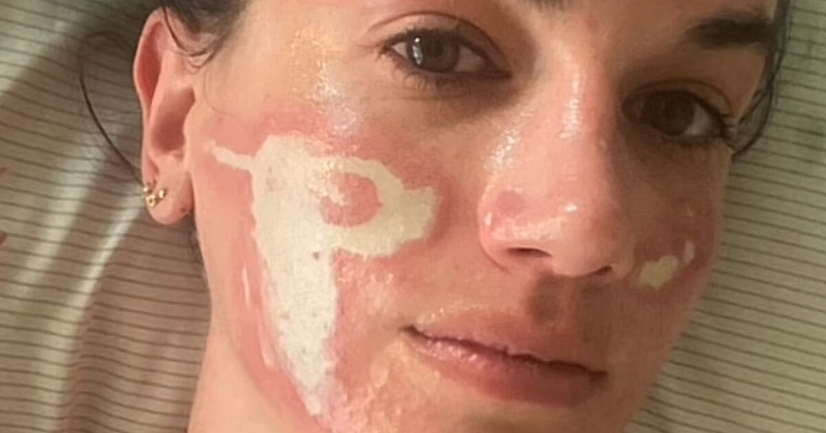 “Altro che estetista di grido, mi ha sfigurata in modo permanente con un peeling per il viso”: la denuncia contro Sonya Dakar è virale su TikTok