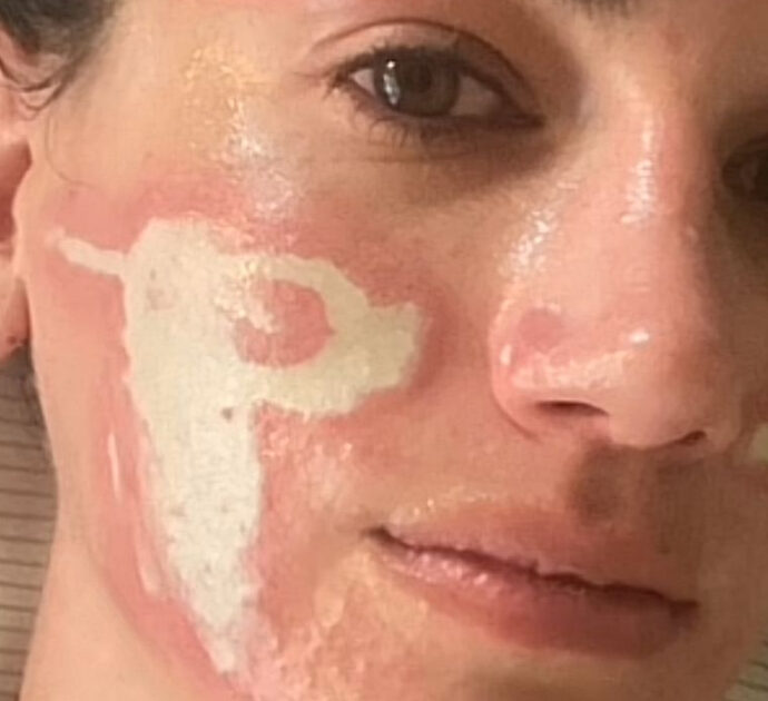 “Altro che estetista di grido, mi ha sfigurata in modo permanente con un peeling per il viso”: la denuncia contro Sonya Dakar è virale su TikTok
