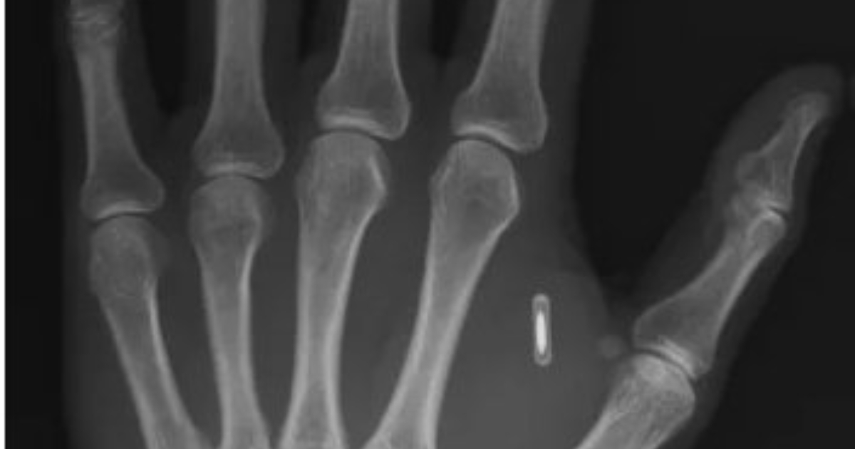 mi sono fatto impiantare un chip nella mano per fare trucchi di magia ma ho dimenticato la password la storia del mago scienziato zi teng wang da Ilfattoquotidiano.it mi sono fatto impiantare un chip nella mano per fare trucchi di magia ma ho dimenticato la password la storia del mago scienziato zi teng wang