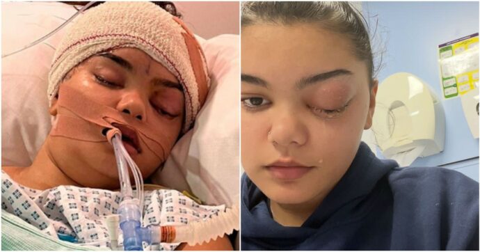 Pensava fosse un semplice raffreddore, poi il suo occhio ha iniziato a gonfiarsi ed “è schizzato fuori come una pallina da golf”: cos’è la cellulite orbitaria e i rischi per il cervello