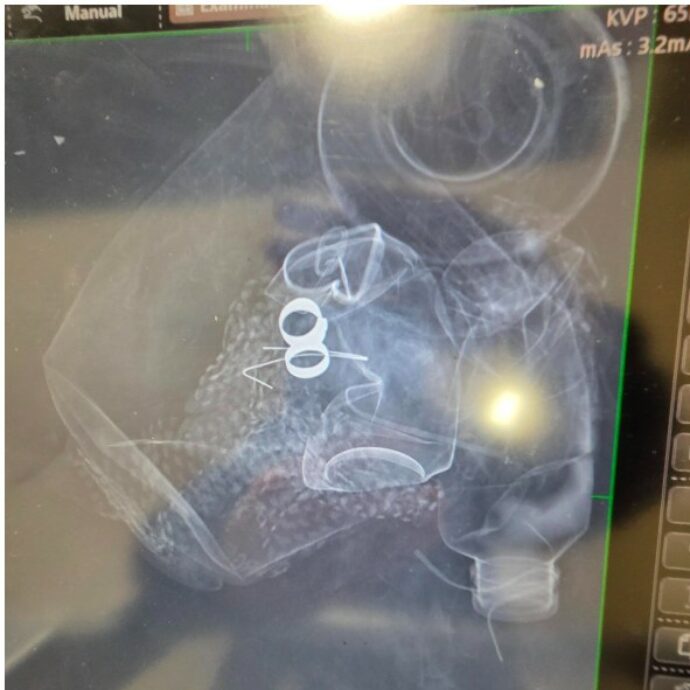 Si toglie i preziosi anelli di famiglia per fare la radiografia e poi li perde: tutto l’ospedale si mobilita e passa ai raggi X la spazzatura per ritrovarli