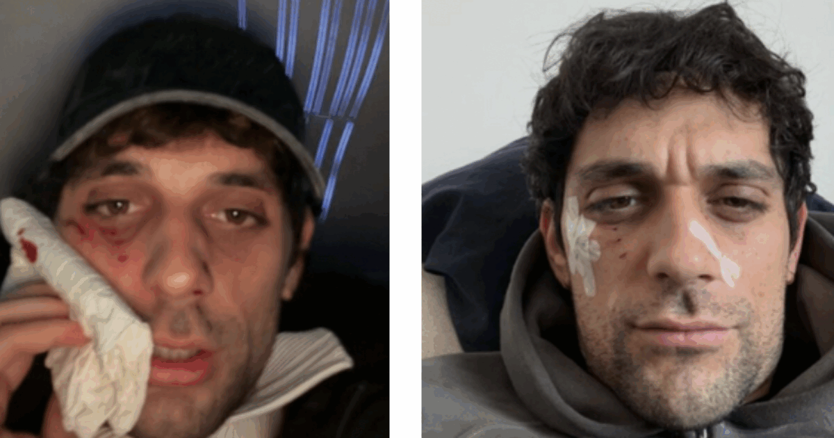 “Ho avuto un piccolo qui pro quo con un dobermann ma l’abbiamo chiusa in maniera diplomatica”: le ferite al volto di Bresh e il ‘lieto fine’