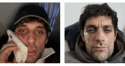 Copertina di “Ho avuto un piccolo qui pro quo con un dobermann ma l’abbiamo chiusa in maniera diplomatica”: le ferite al volto di Bresh e il ‘lieto fine’