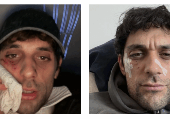 “Ho avuto un piccolo qui pro quo con un dobermann ma l’abbiamo chiusa in maniera diplomatica”: le ferite al volto di Bresh e il ‘lieto fine’