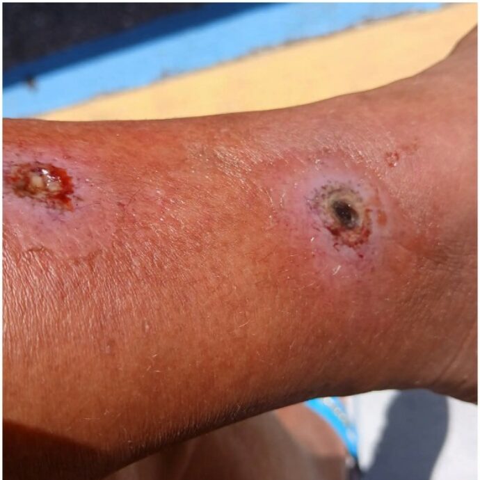 “Mi sono ritrovata la casa infestata dai ragni, anche velenosi. Mi hanno morso ovunque e hanno dovuto amputarmi le dita del piede”: donna fa causa al proprietario dell’appartamento