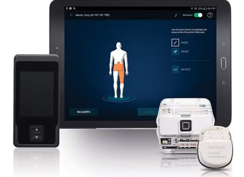 A Verona primo trattamento in Europa per il dolore cronico con elettrodi