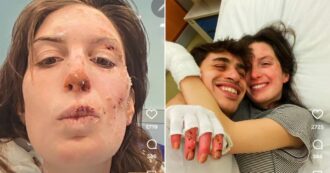 “Dietro ogni articolo e ogni titolo di giornale c’è stata la vita vera”: Eleonora Palmieri mostra sui social il volto ustionato nel rogo di Crans Montana