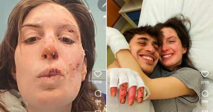 “Dietro ogni articolo e ogni titolo di giornale c’è stata la vita vera”: Eleonora Palmieri mostra sui social il volto ustionato nel rogo di Crans Montana