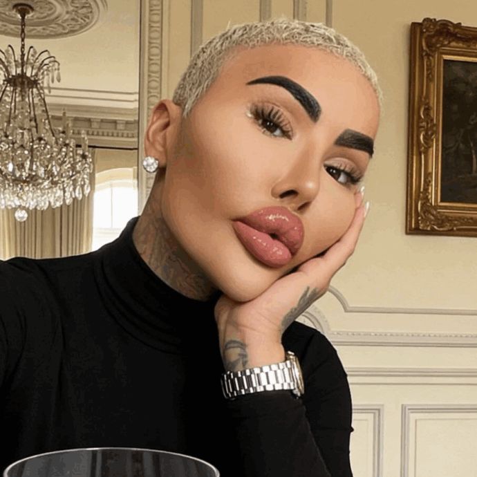 È morto il “re delle labbra” Jordan James Parke dopo un intervento: due arresti per omicidio colposo. La vittima ha speso oltre 150mila dollari in chirurgia plastica