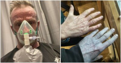 Copertina di “Tutti al pronto soccorso mi fissavano come se avessero visto un fantasma”. L’incredibile caso dell’uomo che si è risvegliato la mattina con il corpo tutto blu