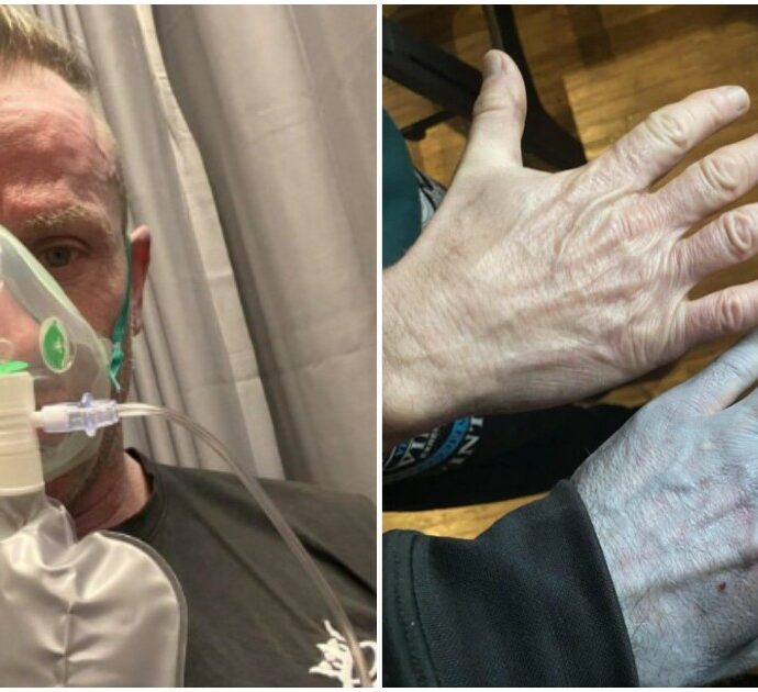 “Tutti al pronto soccorso mi fissavano come se avessero visto un fantasma”. L’incredibile caso dell’uomo che si è risvegliato la mattina con il corpo tutto blu
