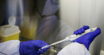 Copertina di Epatite A, Regione Lazio in allerta: 120 casi, 50 a Roma. Potrebbero essere legati al focolaio campano