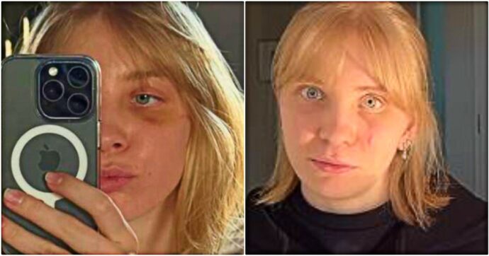 “Ho una placca di titanio sotto l’occhio e la mia vista potrà rimanere per sempre offuscata”: le conseguenze della caduta a Milano-Cortina