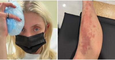 Copertina di “Un ragno enorme ha deciso di staccarmi un pezzo di carne e il suo veleno mi ha fatto un bel po’ di danni”: Taylor Momsen è stata ricoverata in ospedale