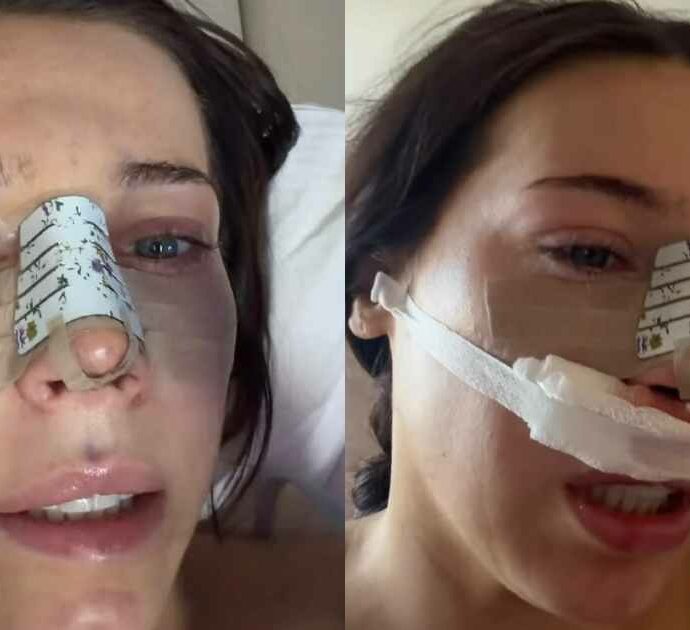 “Io e mamma volevamo avere i nasi abbinati, ma dopo la rinoplastica ho avuto vertigini, mal di testa e nebbia mentale: rischio di non riavere più l’olfatto”. La storia di Erica Roberts
