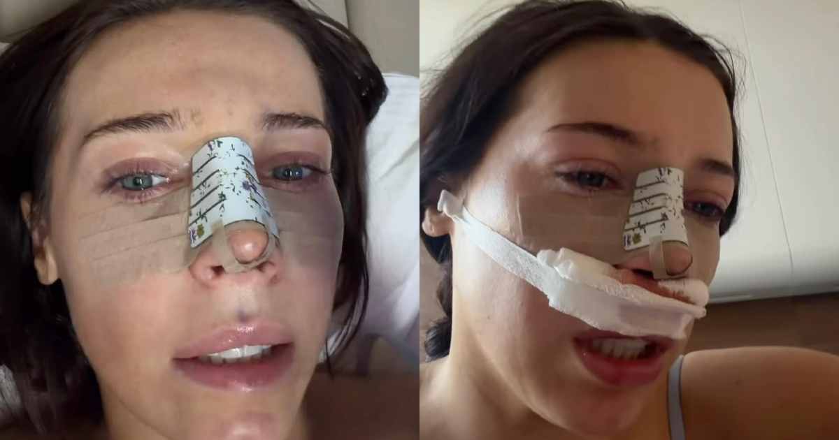 “Io e mamma volevamo avere i nasi abbinati, ma dopo la rinoplastica ho avuto vertigini, mal di testa e nebbia mentale: rischio di non riavere più l’olfatto”. La storia di Erica Roberts