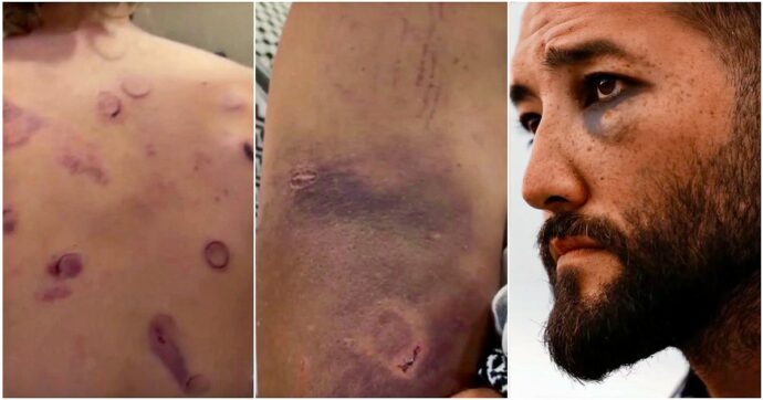 Legali Flotilla: “Pensiamo a denuncia per tortura”. Israele: “Agito secondo le procedure”. Gli attivisti mostrano i lividi e i segni delle violenze