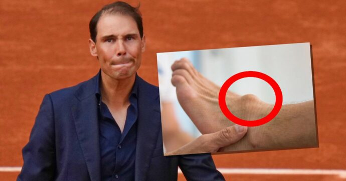 “Dicevano che non avrei mai più giocato. Non era solo una piccola crepa, è una malattia”: la foto del piede deformato di Nadal. Cos’è la sindrome di Müller-Weiss