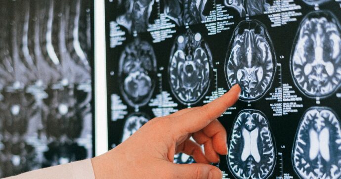 Un malato di Sla con paralisi e difficoltà nel parlare comunica da due anni nella vita di tutti i giorni grazie a un chip impiantato nel cervello