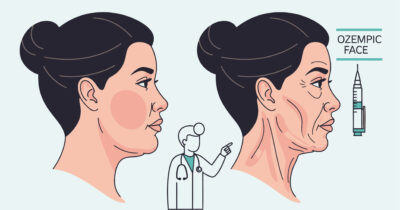 Copertina di “Guance infossate, pelle flaccida, occhi sporgenti: il viso si svuota in modo innaturale ed è molto difficile recuperare tonicità”: così l'”Ozempic Face” sta cambiando i protocolli di medicina estetica